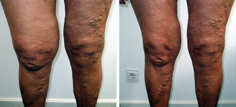 10.09.13 efter 6 behandlinger