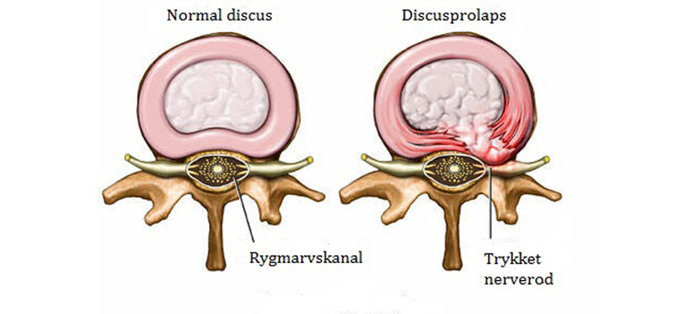Foto-Artikel-MOgens-Dahl-LD-Marts-2015-discusprolaps