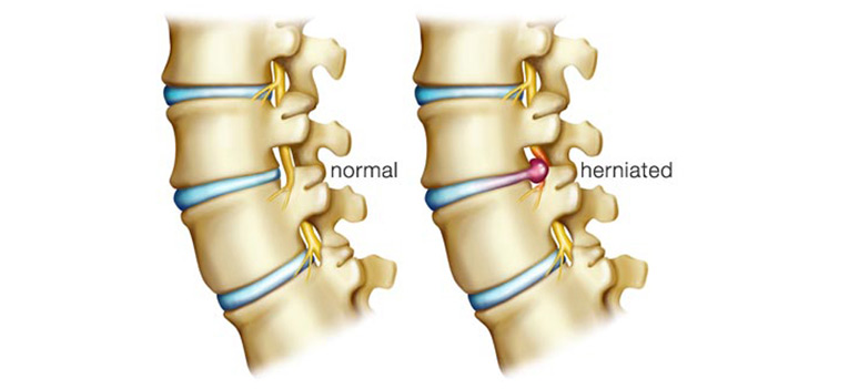 Foto-Artikel-MOgens-Dahl-LD-Marts-2015-herniated-disc