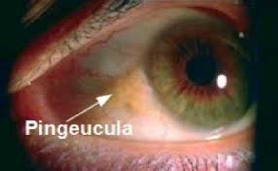 Pingeucula