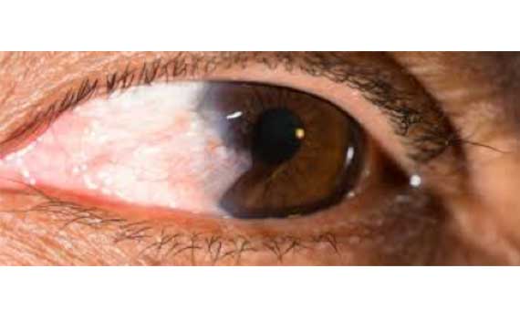 Pterygium